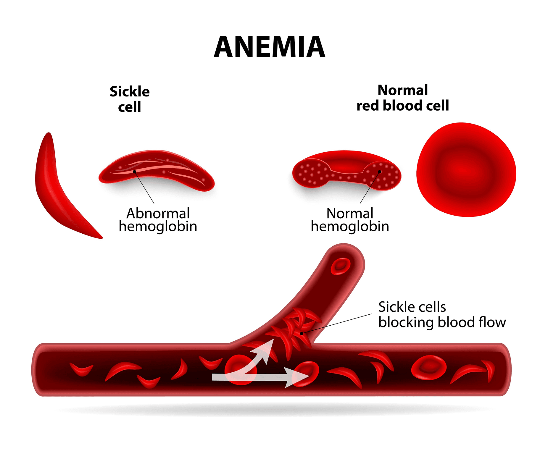 Anemia - Sickle cell vs Normal red blood cell diagram